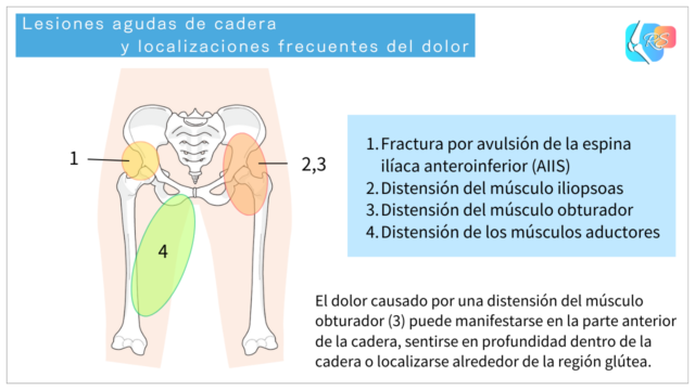 Diagrama de lesiones agudas de cadera y localizaciones frecuentes del dolor