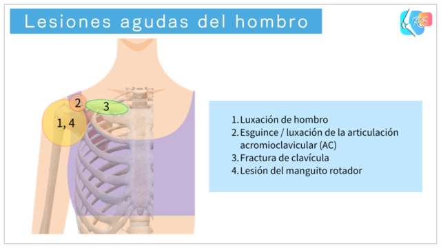 Ilustración de las lesiones agudas más comunes del hombro, como la luxación, la lesión acromioclavicular y la fractura de clavícula