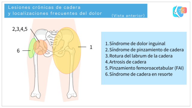 Diagrama de lesiones crónicas de cadera y localizaciones frecuentes del dolor