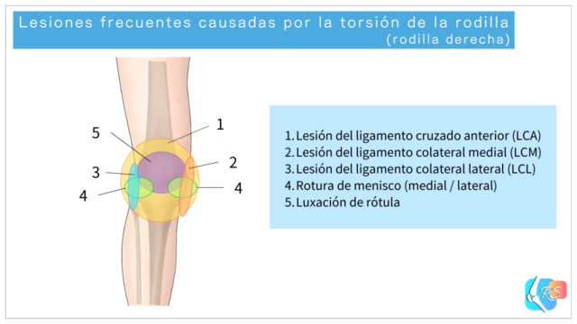 Ilustración que muestra las lesiones más frecuentes causadas por la torsión de la rodilla y las zonas típicas de dolor
