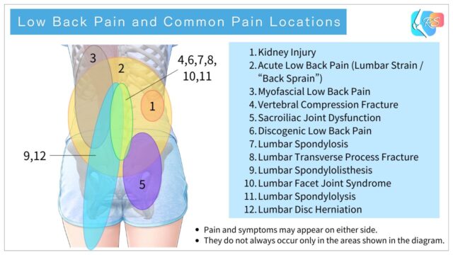 Diagram showing common low back pain conditions and their typical pain locations