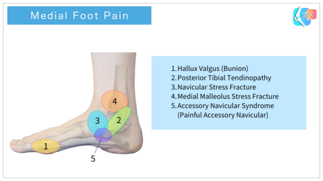 Medial foot pain areas diagram