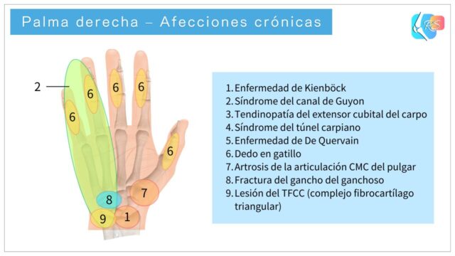 Palma derecha que muestra afecciones crónicas comunes de la mano y la muñeca