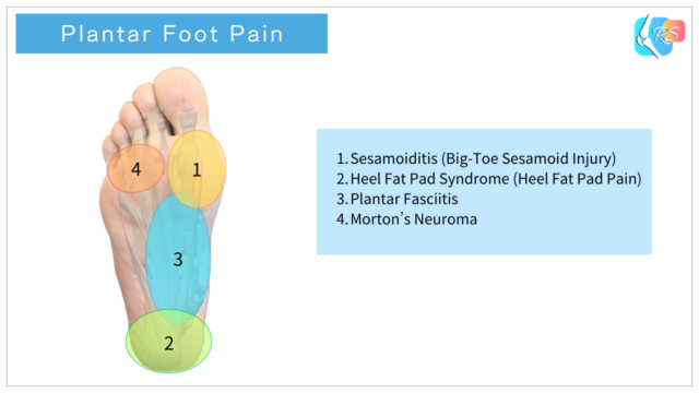 Plantar foot pain areas diagram