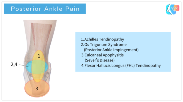 Posterior ankle pain areas diagram