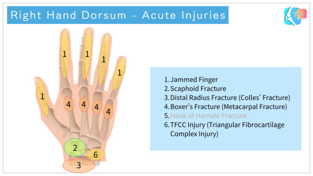 Right hand dorsum illustrating common acute injuries of the fingers, wrist, and carpal bones