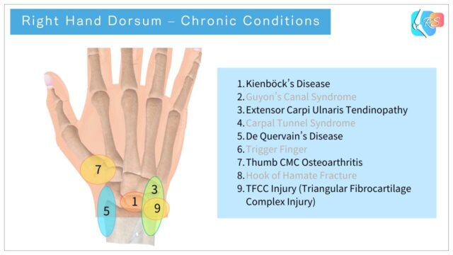 Right hand dorsum illustrating common chronic conditions of the hand and wrist