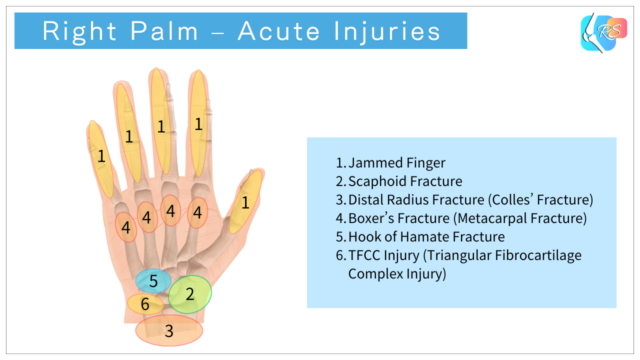 Right palm showing common acute hand injuries including finger, wrist, and carpal bone injuries