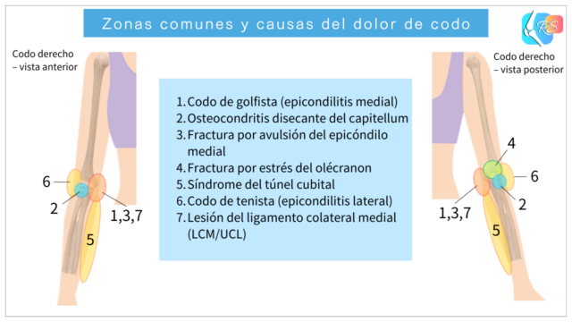 Zonas comunes y causas del dolor de codo en el codo derecho
