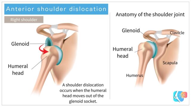 Anterior shoulder dislocation diagram showing the humeral head displaced forward from the glenoid socket