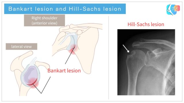 Diagram showing Bankart lesion and Hill-Sachs lesion associated with anterior shoulder dislocation