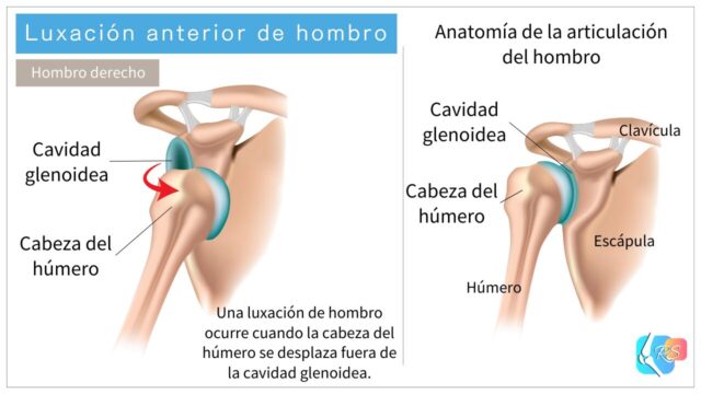 Luxación anterior de hombro con la cabeza del húmero desplazada hacia delante fuera de la cavidad glenoidea