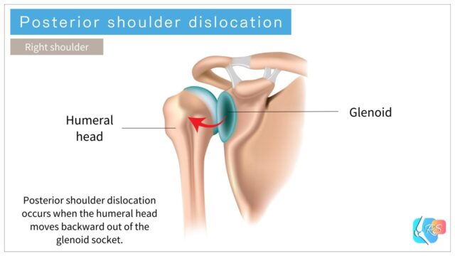 Posterior shoulder dislocation diagram showing the humeral head displaced backward from the glenoid socket