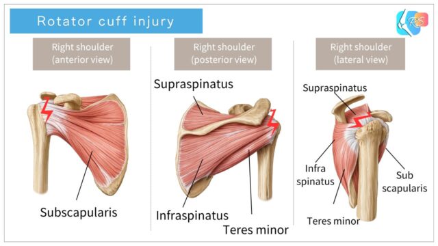 Rotator cuff muscles (supraspinatus, infraspinatus, teres minor, subscapularis) and common injury site in the right shoulder