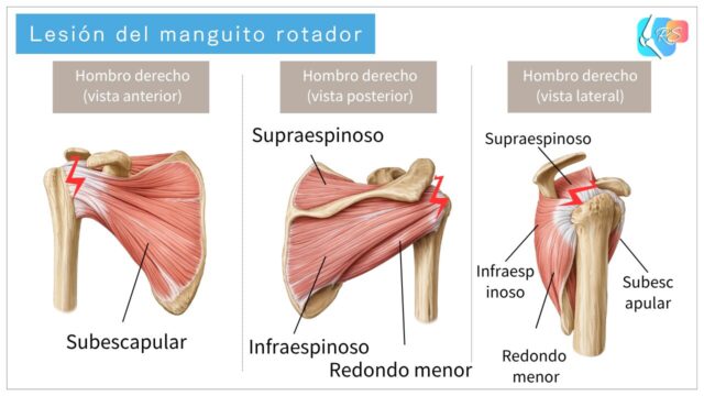 Anatomía del manguito rotador en el hombro derecho con supraespinoso, infraespinoso, redondo menor y subescapular