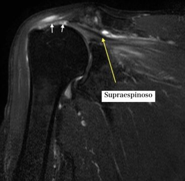 Imagen de resonancia magnética que muestra un desgarro del tendón del supraespinoso en el hombro