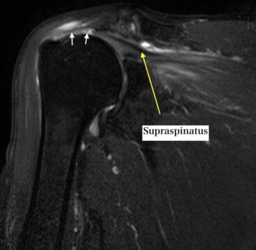 MRI image showing a supraspinatus tendon tear in the shoulder