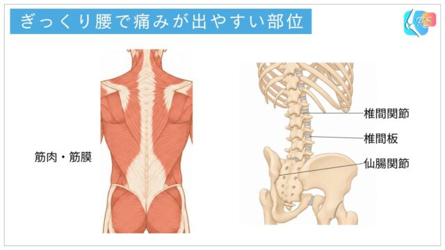 ぎっくり腰で痛みが出やすい部位と腰部の筋肉・筋膜・関節の位置関係を示したイラスト