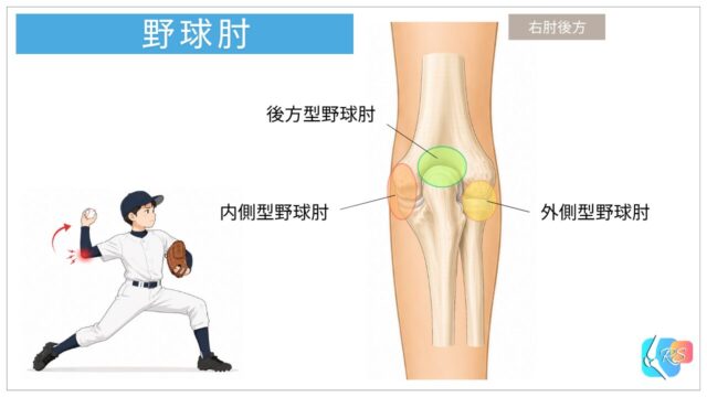 内側型野球肘・外側型野球肘・後方型野球肘の発生部位を示した肘関節のイラスト