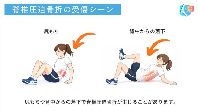 脊椎圧迫骨折の受傷機転（尻もちや背中からの落下）を示した説明図