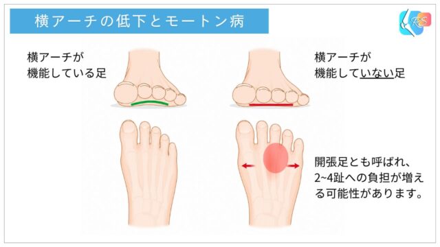 横アーチの低下によって神経が圧迫され、モートン病が発生する仕組み