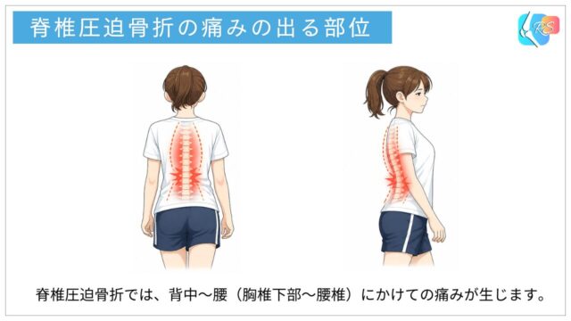 脊椎圧迫骨折で生じやすい痛みの部位（胸椎下部から腰椎）を示したイラスト