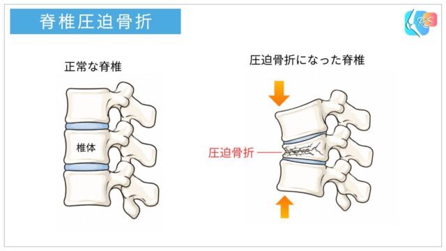 正常な脊椎と脊椎圧迫骨折で椎体がつぶれた状態を比較した説明図