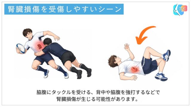 スポーツ中に脇腹や背中へ強い衝撃が加わり腎損傷が発生する受傷機転のイメージ図
