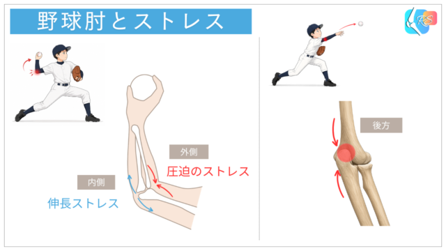 投球動作で生じる肘内側の牽引ストレス、肘外側の圧迫ストレス、肘後方の圧迫ストレスを示したイラスト