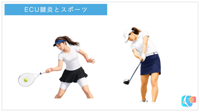 尺側手根伸筋（ECU）腱に関連するスポーツ例として、テニスとゴルフの動作を示したイラスト
