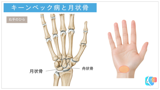 キーンベック病で障害される月状骨の位置を示した手首の解剖イラスト