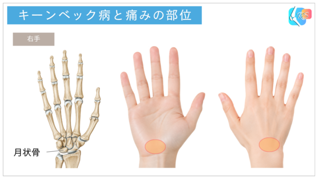 キーンベック病で痛みが出やすい手首中央から甲側の範囲を示したイラスト