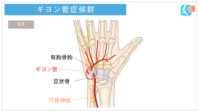 ギヨン管症候群に関係する手首小指側のギヨン管と、尺骨神経・尺骨動脈・豆状骨・有鉤骨鉤の位置を示した解剖イラスト