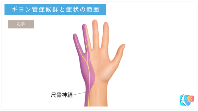 ギヨン管症候群で感覚症状が出やすい小指と薬指の小指側を示した手のイラスト