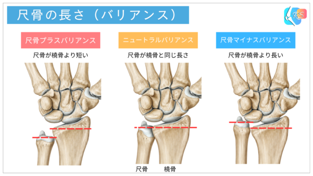 尺骨バリアンスのプラスとマイナスの違いを示した手関節の説明イラスト