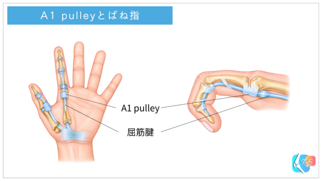 ばね指におけるA1プーリーと屈筋腱の滑走障害を示す模式図
