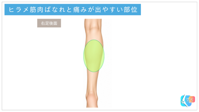 ヒラメ筋肉ばなれで痛みが出やすいふくらはぎの部位を示したイラスト