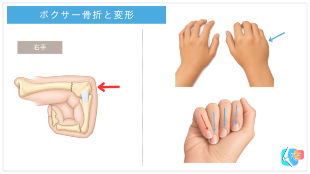 ボクサー骨折による小指側の拳の出っ張りの低下と回旋変形を示した手のイラスト