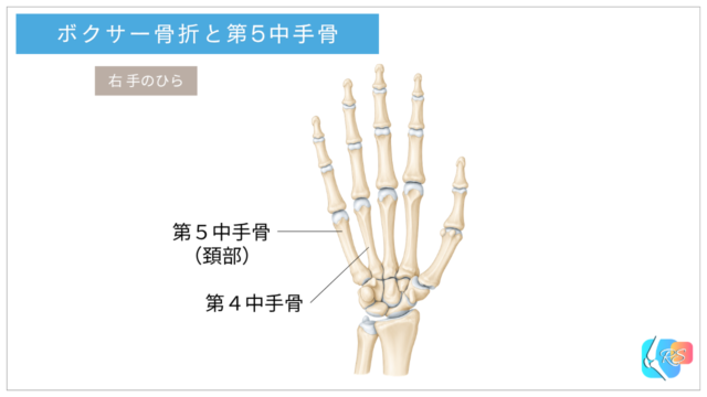 ボクサー骨折が起こりやすい第5中手骨頚部の位置を示した手の骨格イラスト