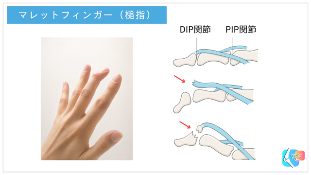 マレットフィンガー(槌指)で終末伸筋腱の付着部が末節骨の骨片とともに剥離し、DIP関節を自力で伸ばせなくなる状態を示した画像