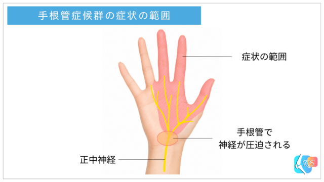 手根管症候群で親指・人差し指・中指と薬指の親指側を中心にしびれが生じやすい範囲を示したイラスト