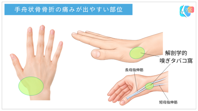 手舟状骨骨折で痛みが出やすい解剖学的嗅ぎタバコ窩と母指伸筋腱を示したイラスト