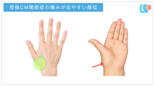 母指CM関節症で痛みが出やすい親指の付け根の部位と、関節周囲の形状変化を示したイラスト