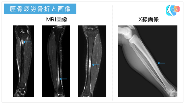 脛骨疲労骨折の画像例。疾走型の近位部MRI、遠位部MRI、跳躍型のMRI、跳躍型のレントゲン画像を示した図。