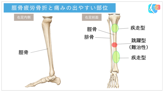 脛骨疲労骨折の好発部位を示すイラスト。疾走型は脛骨の中〜遠位1/3の後内側や近位1/3、跳躍型(難治性)は脛骨骨幹部中央付近の前方皮質にみられる。