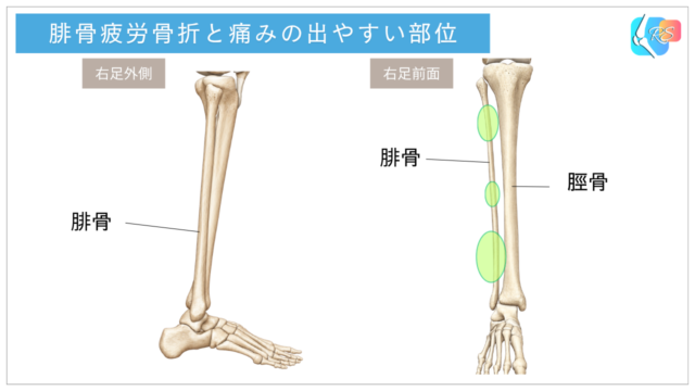 腓骨疲労骨折の好発部位 遠位1/3 近位1/3 中央1/3