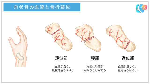 血流と舟状骨骨折の部位(遠位部・腰部・近位部)を示したイラスト
