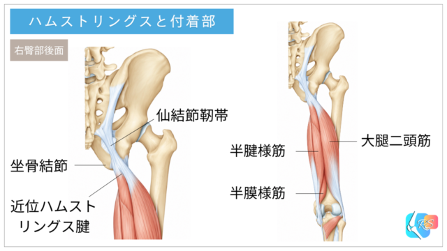 ハムストリングスの解剖図。右臀部後面から見た坐骨結節と近位ハムストリング腱の付着部、半腱様筋・半膜様筋・大腿二頭筋の位置を示す。