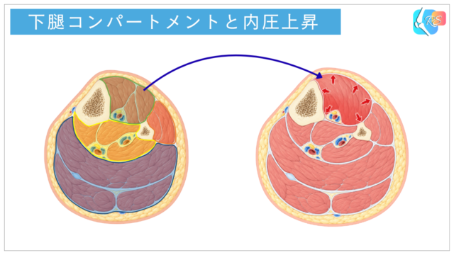 下腿コンパートメント症候群の模式図。前方区画の筋肉が腫脹し、筋膜に囲まれた区画内の圧が上昇している状態を示す横断面イラスト。