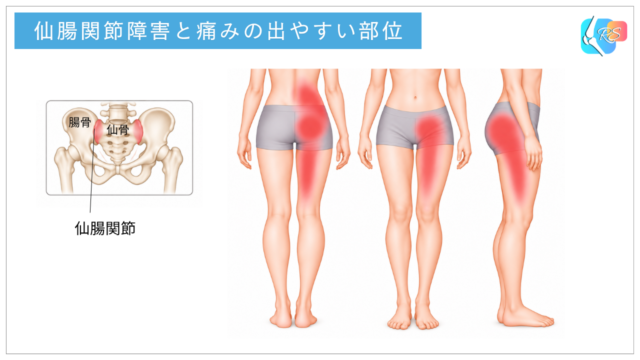 仙腸関節障害で痛みが出やすい腰の下部・臀部・鼠径部・太ももの範囲を示したイラスト
